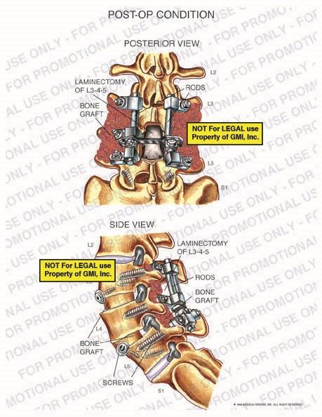 Post Op Condition 97122a19a Generic Medical Legal Exhibits A Division Of Mvi