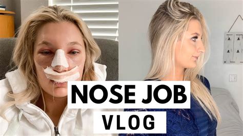 Rhinoplasty Nose Job Vlog Cast Removal With Before And After Photos Youtube