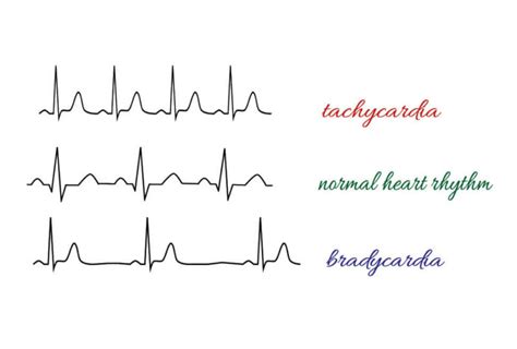 Junctional Rhythm The Definitive Guide Biology Dictionary