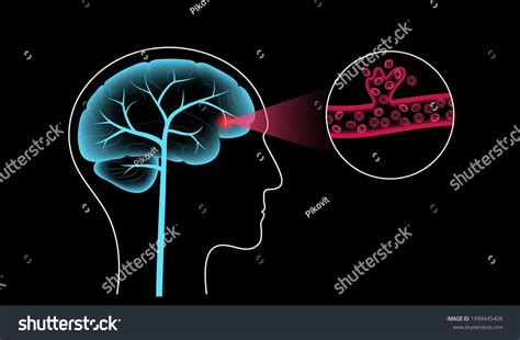 Hemorrhagic Brain Stroke Concept Apoplexy Cerebral Stock Vector Royalty Free 1999445408