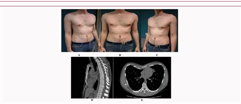 Figure 2 From Correction Of Pectus Excavatum Anterior Chest Wall