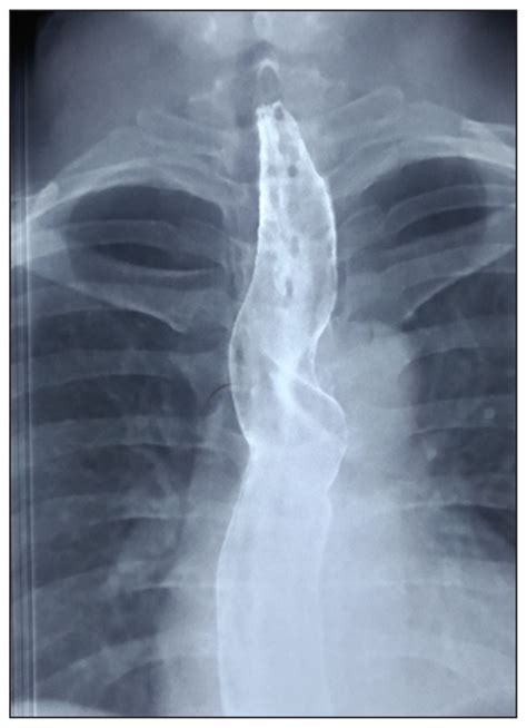 Image Diagnosis Dysphagia Lusoria—an Unusual Cause Of Dysphagia