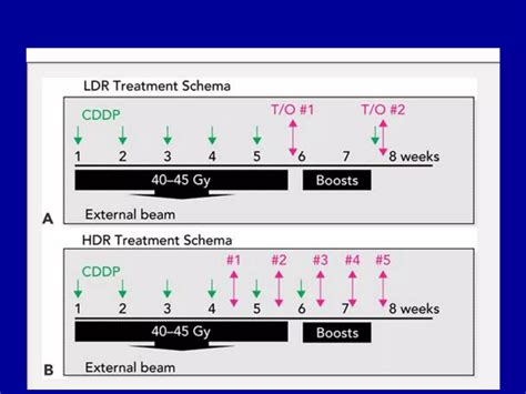 brachytherapy | PPT