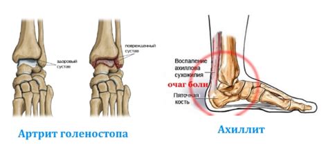Боль в голеностопе: причины, симптомы и лечение
