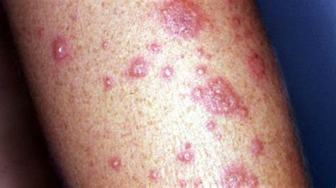 Erythema Multiforme : Treatment and Symptoms