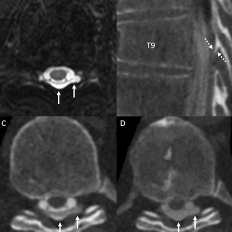 Axial T2w Mr Image At T9 A Shows A Left Eccentric Dorsal Epidural