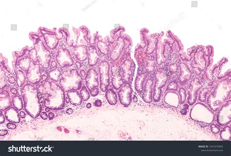 Colonoscopy Polyps Images Images: Browse 69 Stock Photos & Vectors Free Download with Trial ...