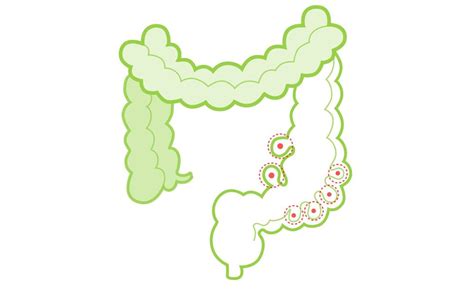 Diverticulitis Cuáles Son Las Causas Síntomas Diagnósticos Y Remedios