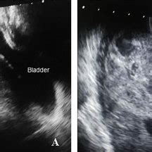 A Gray Scale Transvaginal View Arrow Shows Normal Echogenic