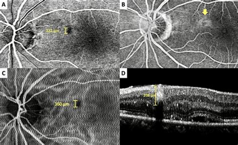 Full Article Intraretinal Macroaneurysms And Multimodal Imaging A