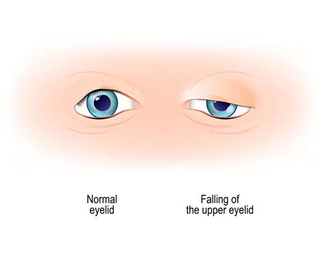 Eyelid Ptosis Symptoms and Treatment - Clinique VisionPros