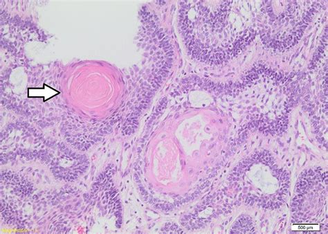 Ameloblastoma Histology