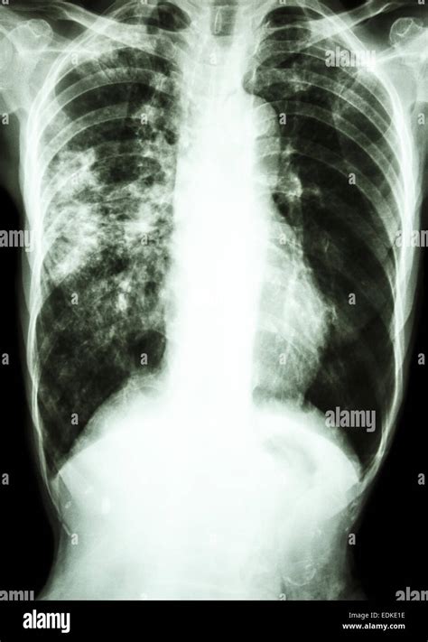 Film Chest X Ray Show Alveolar Infiltrate At Right Lung Due To Mycobacterium Tuberculosis