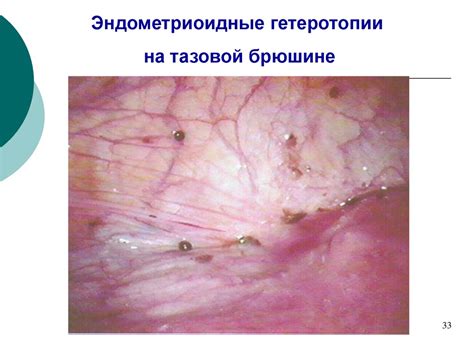Эндометриоз - презентация онлайн