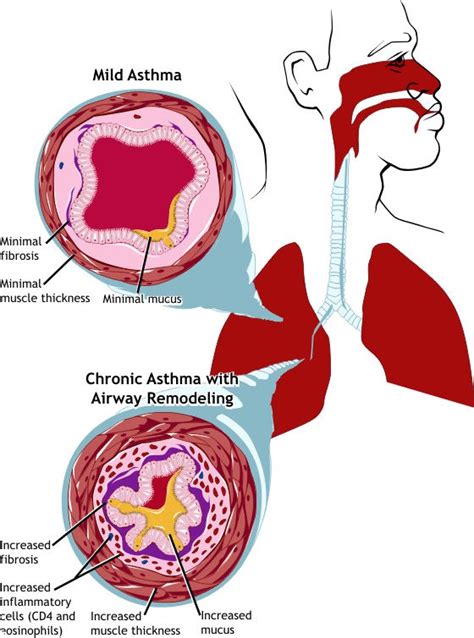 Asthma Overview