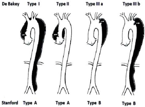 Type B Aortic Dissection Diagnosis Treatment And Management Intechopen
