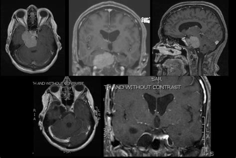 Skull-Base Surgery - New Jersey Brain and Spine