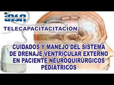 Sistema De Drenaje Ventricular Externo En Pacientes Neuroquirurg Cos