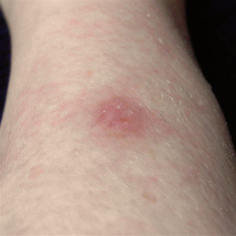 Wolf spider bite - ninebasta 