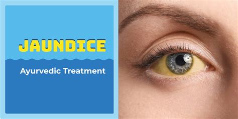 Jaundice Treatment In Ayurveda