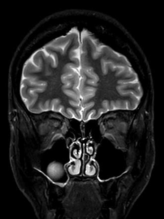 Dacryops | Image | Radiopaedia.org