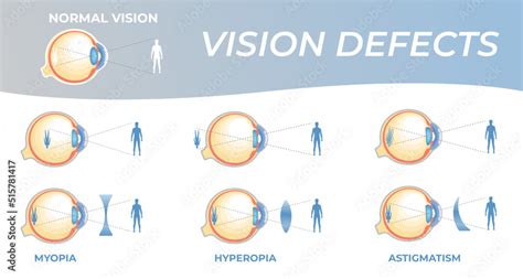 Vision Defects And Their Correction With Intraocular Lenses Vision