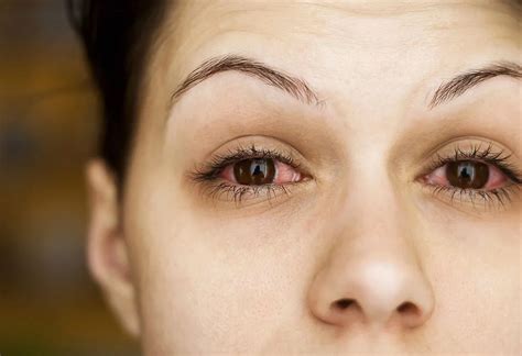 Conjunctivitis In Pregnancy Causes Symptoms And Treatment