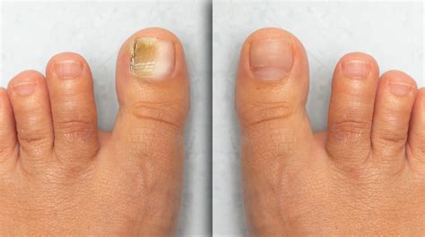 The Importance Of Timely Diagnosis And Treatment For Fungal Nail