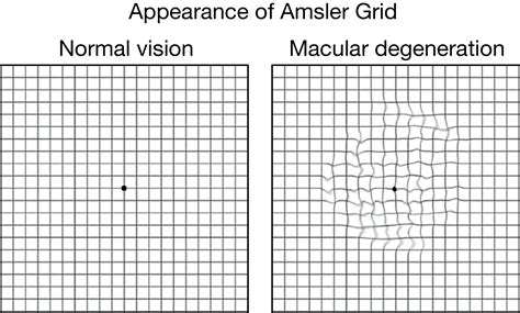 Age Related Macular Degeneration Geriatrics Jama Jama Network