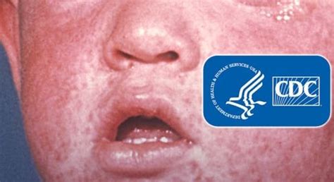CDC Issues Fear Porn Alert For Measles Sons Of Liberty Media