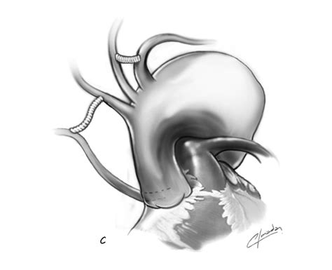 Carotid Subclavian Bypass