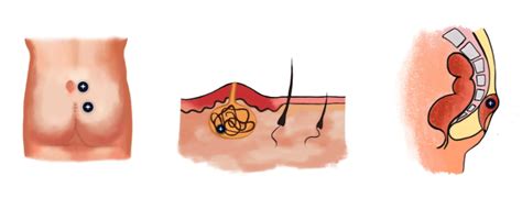 Do You Have Anal Warts How To Avoid And Treat Them Colon Rectal Surgery New York