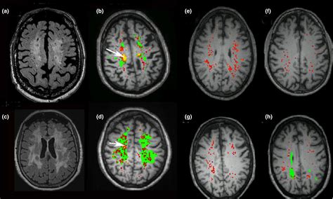 Binswanger Disease Causes Signs And Symptoms Diagnosis 42 Off