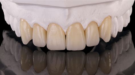 Zirconia Prettau Anterior Zirkonzahn Worldwide