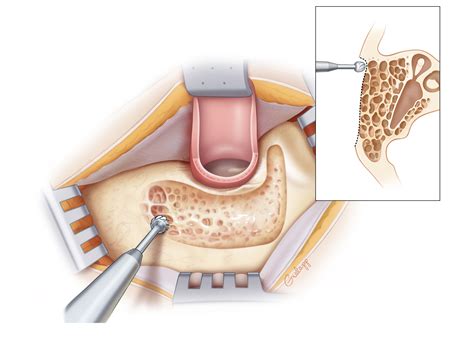 Intact Canal Wall Mastoidectomy Oto Surgery Atlas