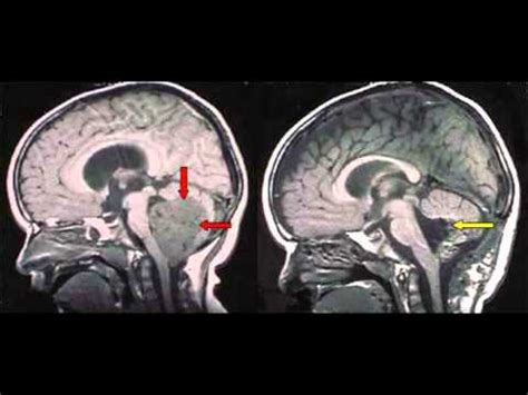 Malignant Brain Tumors In Children Will Soon Be Able To Be Curable ...