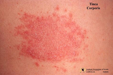 Tinea Lesions