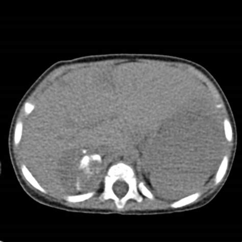 Neuroblastoma With Skull Metastases Image Radiopaedia Org