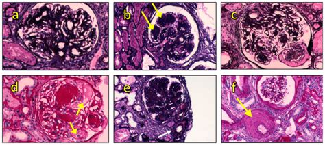 Morphological Spectrum Of Diabetic Nephropathy A Diffuse Mesangial