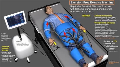 External Counterpulsation Stimulation Combined With Acupuncture For