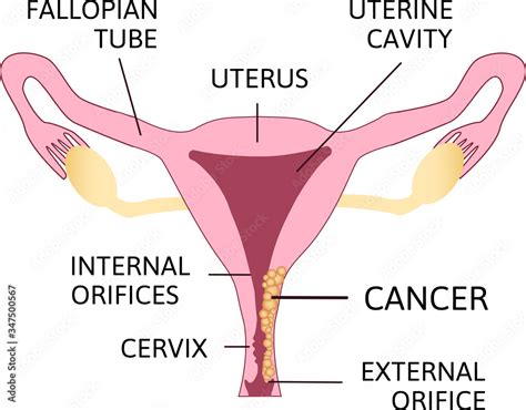 Cervical Cancer Carcinoma Of Cervix Malignant Neoplasm Arising From