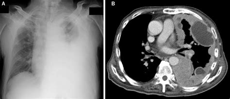 Figure1 Chest X Ray A And Chest Ct B At The Time Of Admission