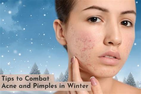 7 Tips To Combat Acne And Pimples In Winter Skinqure