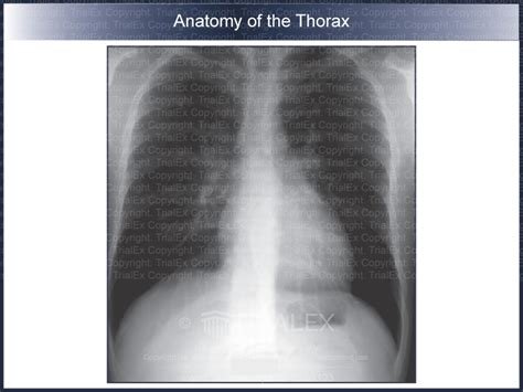 Anatomy of the Thorax: X-ray - TrialQuest Inc.