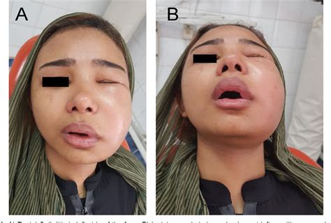 Figure 1 From Intra Oral Incision In Facial Cellulitis Without Fluctuation A Case Report