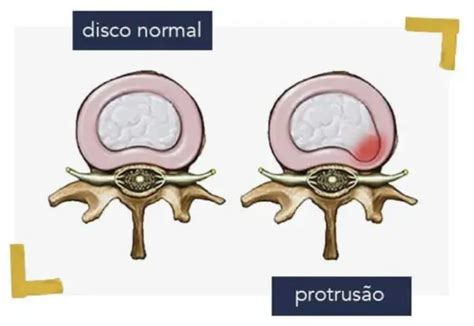 Protusão discal tem cura Dr William Zarza