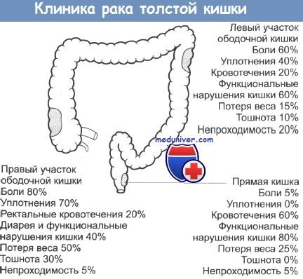 Местный рецидив рака прямой кишки - причины, признаки, лечение