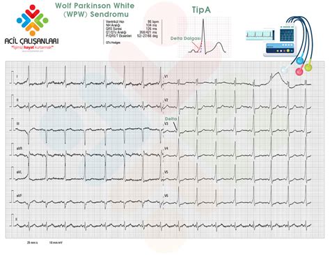 Ekg 024 Wolf Parkinson White Wpw Sendromu