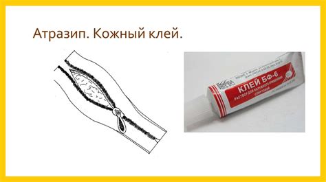 Кожный шов в хирургии - презентация онлайн
