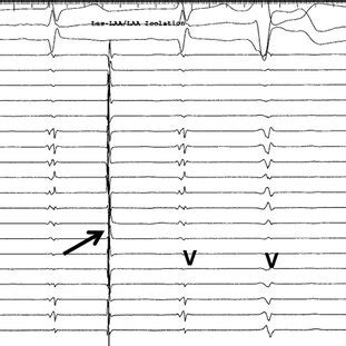 Laa Potential Isolation During Sinus Rhythm While The Circular Mapping